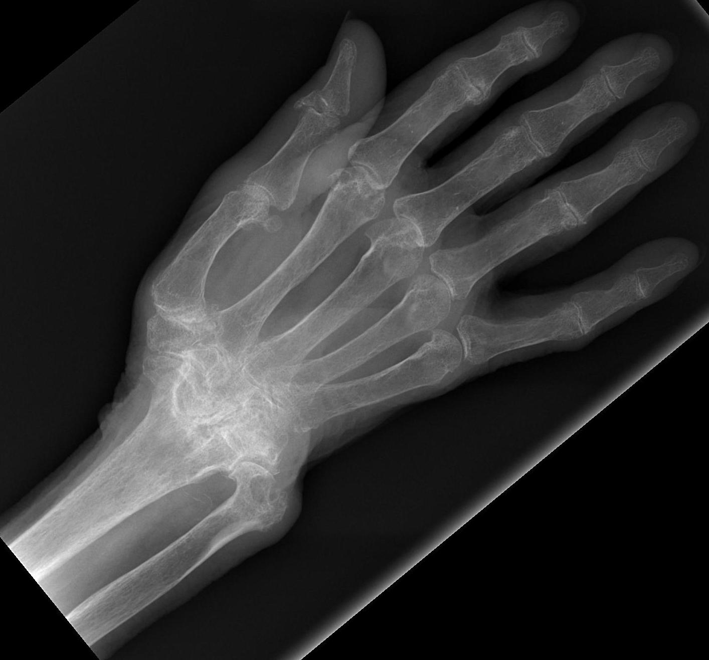 Rheumatoid Wrist